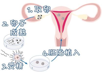 正规有偿捐卵